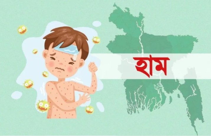 হামের উপসর্গে আরও ৫ শিশুর মৃত্যু আক্রান্ত ১৪১১