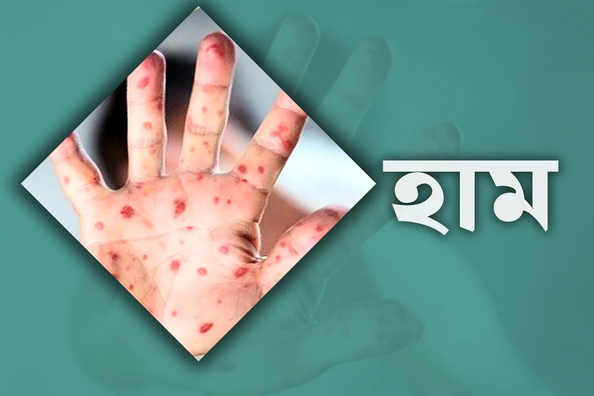 দেশে হাম উপসর্গ নিয়ে ৭ শিশুর মৃত্যু