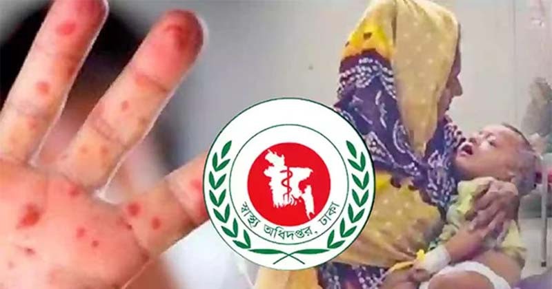 হাম উপসর্গে ২ শিশুর মৃত্যু, আক্রান্ত ৯৭৯