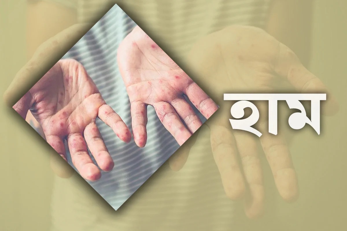হাম উপসর্গে আরও ৫ প্রাণহানি
