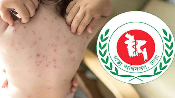 গত ২৪ ঘণ্টায় হামের উপসর্গে আরও ২ জনের মৃত্যু