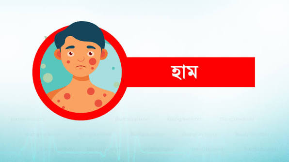 চাঁপাইনবাবগঞ্জে গত ২৪ ঘণ্টায় হাম সন্দেহভাজন শনাক্ত ১