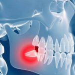 কখন আক্কেল দাঁত তোলা উচিত