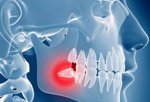 কখন আক্কেল দাঁত তোলা উচিত