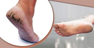 এখনই শীতে হাত-পা ফাটা থেকে মুক্তি পেতে ব্যবস্থা নিন