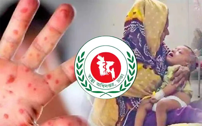 ২৪ ঘণ্টায় হাম উপসর্গে ৫ জনের মৃত্যু