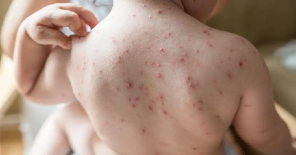 চাঁপাইনবাবগঞ্জে হাম সন্দেহভাজন আরো ২৫ শিশু ভর্তি