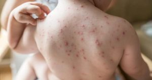 চাঁপাইনবাবগঞ্জে হাম সন্দেহভাজন আরো ২৫ শিশু ভর্তি