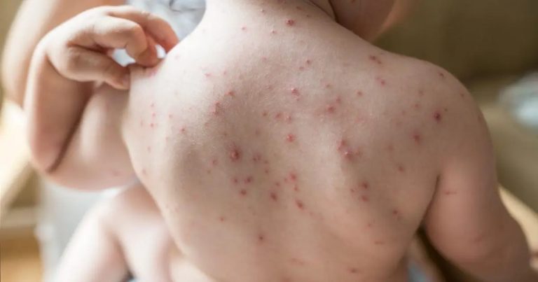 হাম ও হাম সন্দেহে আরও ৫ শিশুর মৃত্যু