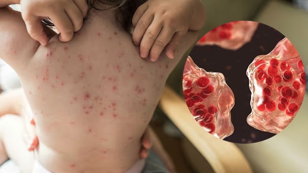 হাম ও উপসর্গ নিয়ে আরও ৩ শিশুর মৃত্যু