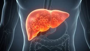 বিশ্বে ১৮০ কোটি মানুষ মেটাবলিক লিভার ডিজিজে আক্রান্ত হবে