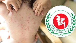 আরও ১১ জনের মৃত্যু হামের উপসর্গ নিয়ে