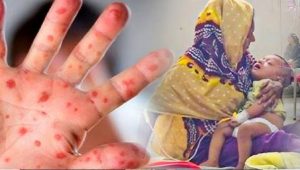 হামে আক্রান্ত ৪ জনের মৃত্যু আক্রান্ত ১১৯৭