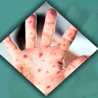 সন্দেহজনক হামে আক্রান্ত চাঁপাইনবাবগঞ্জের আরও এক শিশুর মৃত্যু