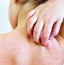 চাঁপাইনবাবগঞ্জে হাসপাতালে ভর্তি হাম সন্দেহভাজন আরো ৩৫ শিশু