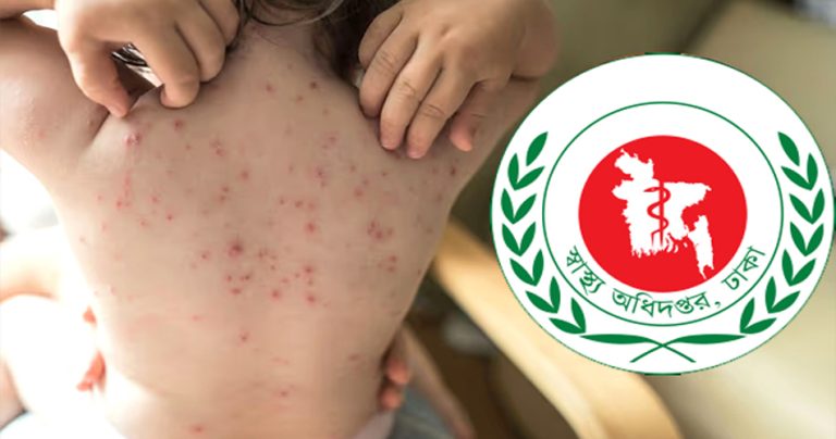 হাম ও উপসর্গ নিয়ে ৮ শিশুর মৃত্যু