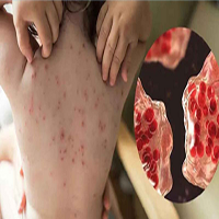 হাম ও উপসর্গ নিয়ে আরও ১০ শিশুর মৃত্যু