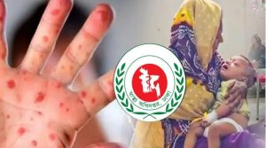 আরও ১০ শিশুর মৃত্যু হাম ও উপসর্গে