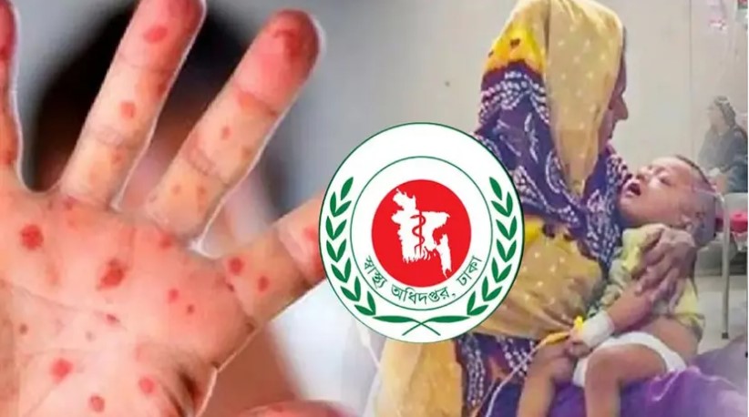 আরও ১০ শিশুর মৃত্যু হাম ও উপসর্গে